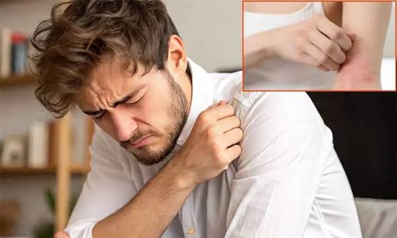 வியர்க்குருவை விரட்ட 10 எளிய வழிமுறைகள்