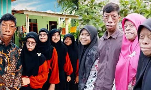 இந்தோனேசியா: அரிய நோயால் குடும்பமே பாதிப்பு; சமூக ஊடகம் வாயிலாக பிரபலம்