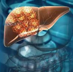 கல்லீரல் பாதிக்கப்பட்ட 2 நோயாளிகளின் மனைவிகளிடம் இருந்து தானம் பெற்ற கல்லீரல்களை பரஸ்பரம் மாற்றி பொருத்தி சிகிச்சை