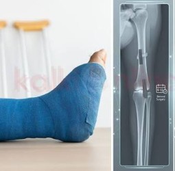 3 மாசத்துல கரைஞ்சு போகும் 'ரீசார்ஜபிள் பிளேட்' - எலும்பு முறிவை சரிசெய்யும் மேஜிக்!