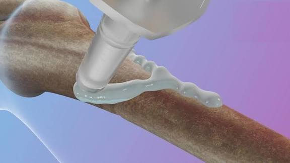 முறிந்த எலும்புகளை மூன்றே நிமிடத்தில் ஒட்ட வைக்கும் பசை: சீன விஞ்ஞானிகள் கண்டுபிடிப்பு