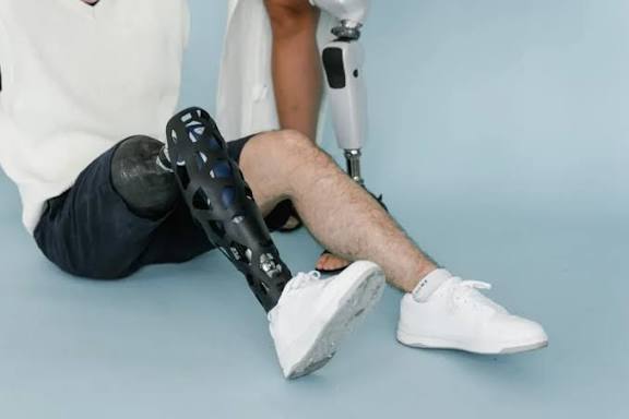 திருப்பூரில் கால் இழந்த 15 பேருக்கு இலவச செயற்கை கால்