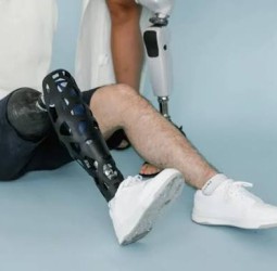 திருப்பூரில் கால் இழந்த 15 பேருக்கு இலவச செயற்கை கால்