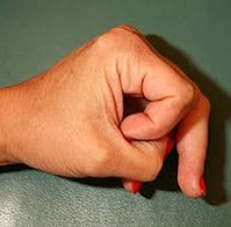 விரல் முறிந்த கவிஞன்